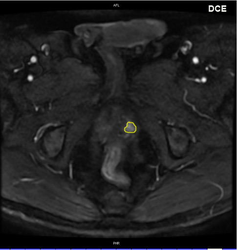 MRT_prostata_DCE_2