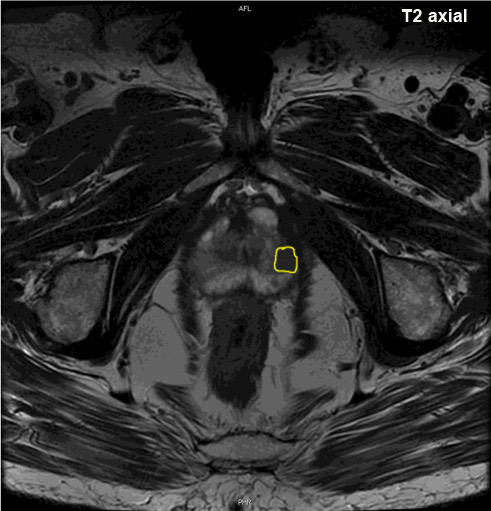 MRT_prostata_T2_2